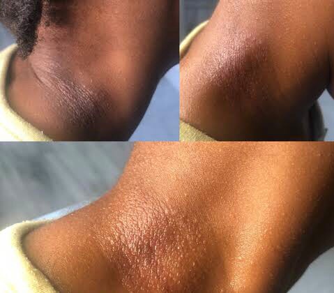 Heat Rashes on my neck